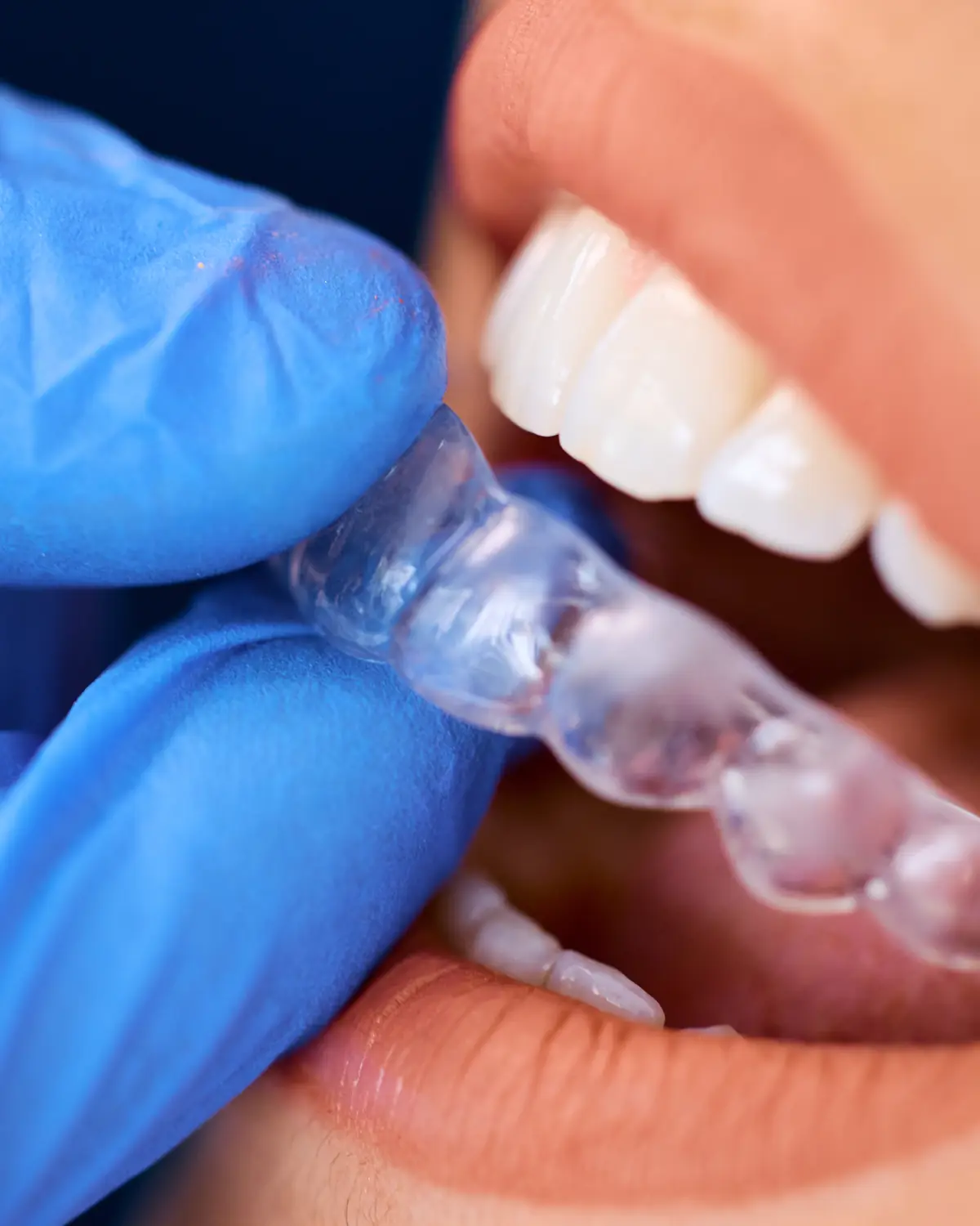 Odontólogo colocando un dispositivo bucal a medida para evaluación de bruxismo en Oral Health, Recoleta